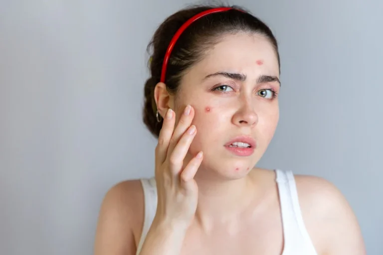 Banishing Pimples Naturally